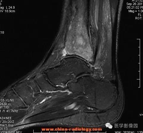 【病例】胫骨骨脓肿1例MR影像表现