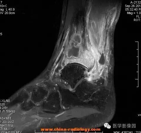 【病例】胫骨骨脓肿1例MR影像表现