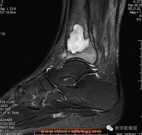 【病例】胫骨骨脓肿1例MR影像表现