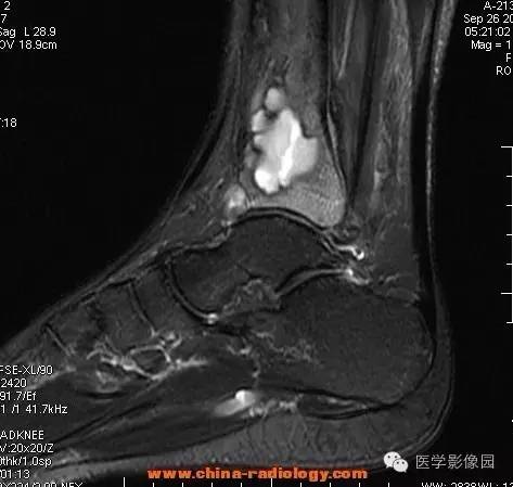 【病例】胫骨骨脓肿1例MR影像表现