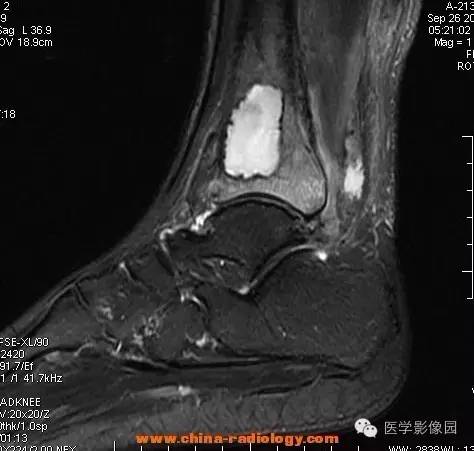 【病例】胫骨骨脓肿1例MR影像表现