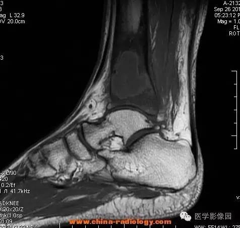 【病例】胫骨骨脓肿1例MR影像表现