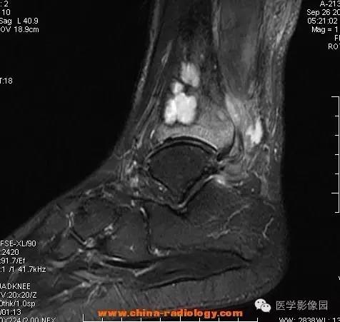 【病例】胫骨骨脓肿1例MR影像表现
