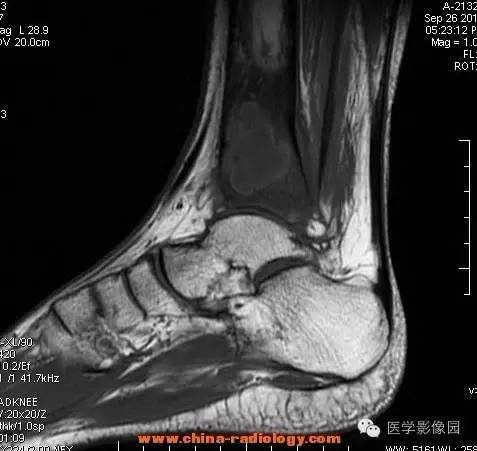 【病例】胫骨骨脓肿1例MR影像表现