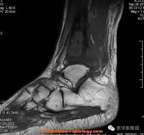 【病例】胫骨骨脓肿1例MR影像表现
