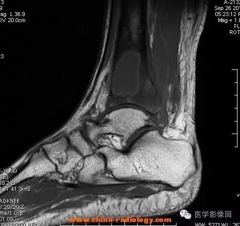 【病例】胫骨骨脓肿1例MR影像表现