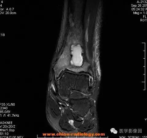 【病例】胫骨骨脓肿1例MR影像表现