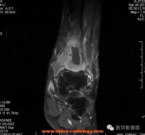 【病例】胫骨骨脓肿1例MR影像表现