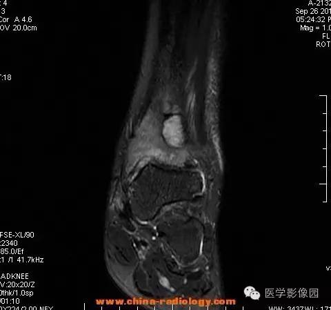 【病例】胫骨骨脓肿1例MR影像表现