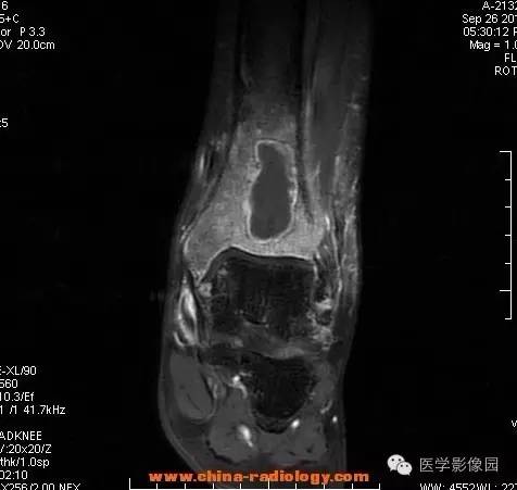 【病例】胫骨骨脓肿1例MR影像表现