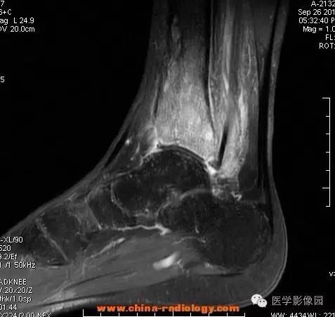 【病例】胫骨骨脓肿1例MR影像表现