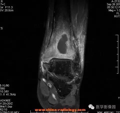 【病例】胫骨骨脓肿1例MR影像表现