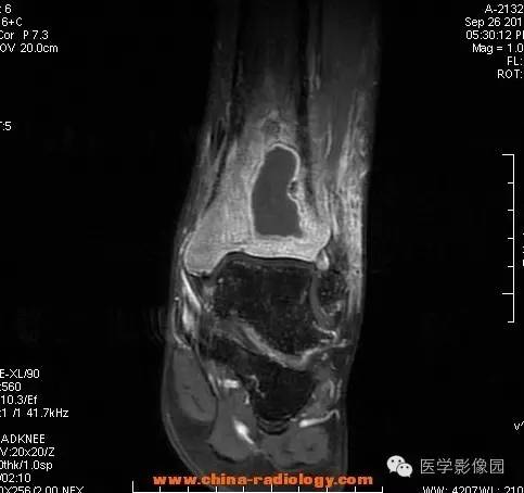 【病例】胫骨骨脓肿1例MR影像表现