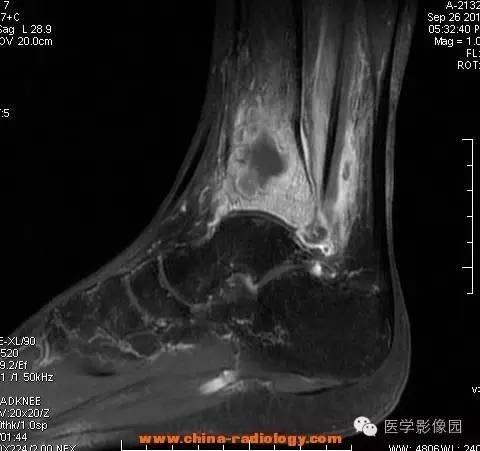 【病例】胫骨骨脓肿1例MR影像表现