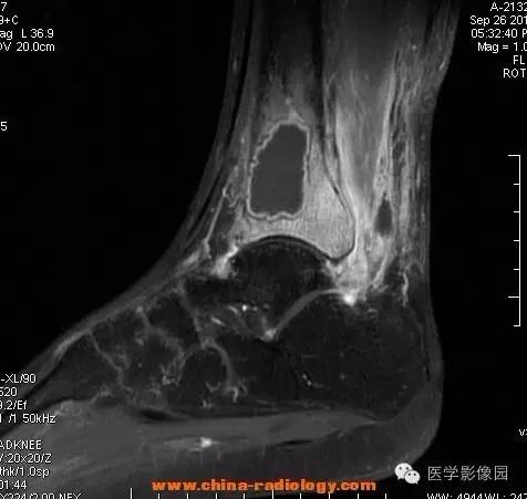 【病例】胫骨骨脓肿1例MR影像表现