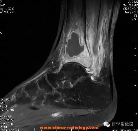 【病例】胫骨骨脓肿1例MR影像表现
