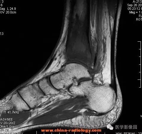 【病例】胫骨骨脓肿1例MR影像表现