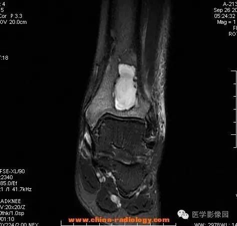 【病例】胫骨骨脓肿1例MR影像表现
