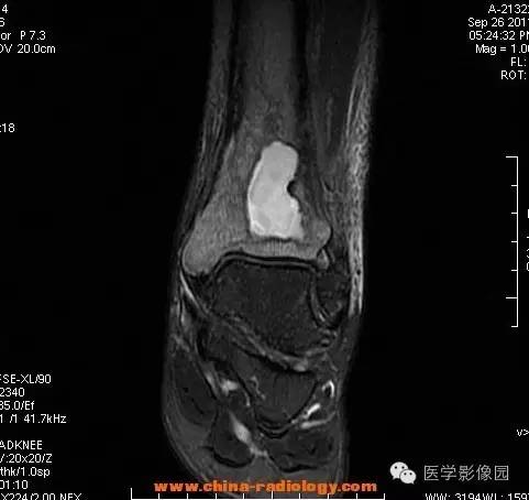 【病例】胫骨骨脓肿1例MR影像表现