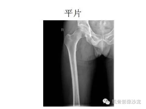 【病例】耻骨去分化软骨肉瘤一例X线及MR 【病例】耻骨去分化软骨肉瘤一例X线及MR