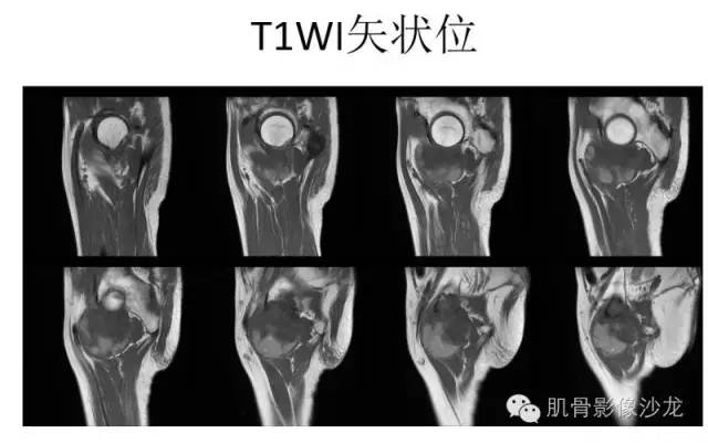 【病例】耻骨去分化软骨肉瘤一例X线及MR 【病例】耻骨去分化软骨肉瘤一例X线及MR