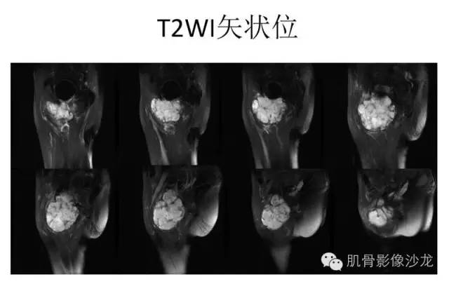 【病例】耻骨去分化软骨肉瘤一例X线及MR 【病例】耻骨去分化软骨肉瘤一例X线及MR