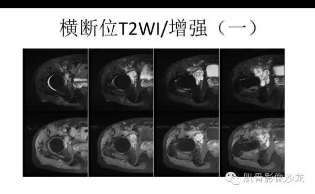 【病例】耻骨去分化软骨肉瘤一例X线及MR 【病例】耻骨去分化软骨肉瘤一例X线及MR