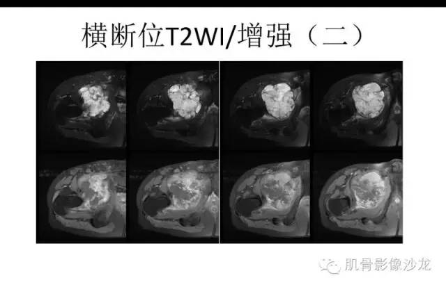【病例】耻骨去分化软骨肉瘤一例X线及MR 【病例】耻骨去分化软骨肉瘤一例X线及MR