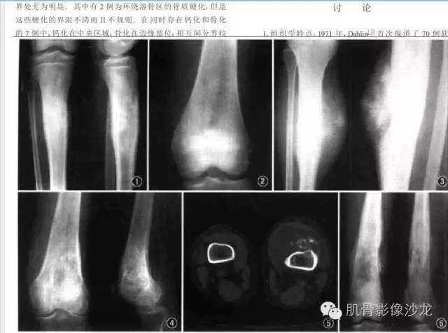 【病例】耻骨去分化软骨肉瘤一例X线及MR 【病例】耻骨去分化软骨肉瘤一例X线及MR