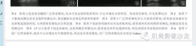 【病例】耻骨去分化软骨肉瘤一例X线及MR 【病例】耻骨去分化软骨肉瘤一例X线及MR