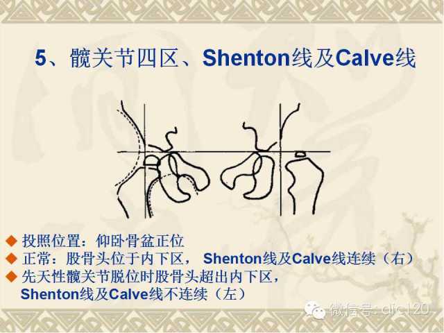 【PPT】髋关节及膝关节常用X线测量简图