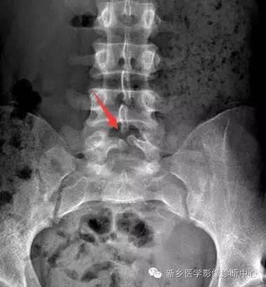 脊柱裂——隐性脊柱裂、脊膜膨出、脊髓脊膜膨出 脊柱裂——隐性脊柱裂、脊膜膨出、脊髓脊膜膨出