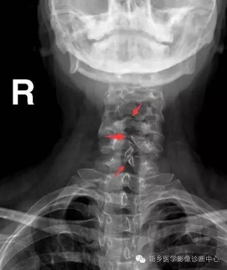 脊柱裂——隐性脊柱裂、脊膜膨出、脊髓脊膜膨出 脊柱裂——隐性脊柱裂、脊膜膨出、脊髓脊膜膨出