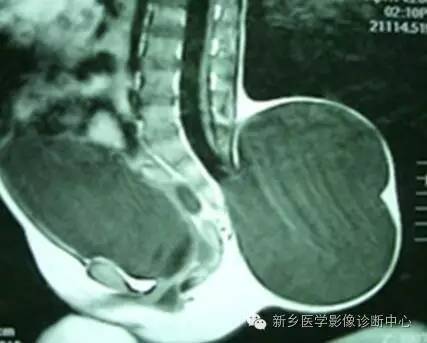 脊柱裂——隐性脊柱裂、脊膜膨出、脊髓脊膜膨出 脊柱裂——隐性脊柱裂、脊膜膨出、脊髓脊膜膨出