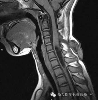 脊柱裂——隐性脊柱裂、脊膜膨出、脊髓脊膜膨出 脊柱裂——隐性脊柱裂、脊膜膨出、脊髓脊膜膨出