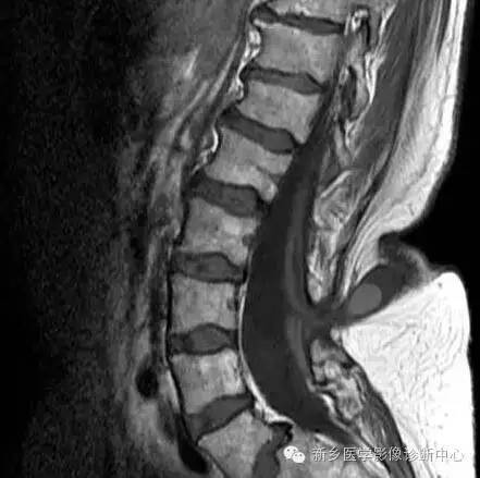 脊柱裂——隐性脊柱裂、脊膜膨出、脊髓脊膜膨出 脊柱裂——隐性脊柱裂、脊膜膨出、脊髓脊膜膨出