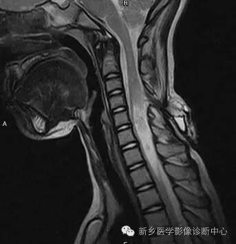 脊柱裂——隐性脊柱裂、脊膜膨出、脊髓脊膜膨出 脊柱裂——隐性脊柱裂、脊膜膨出、脊髓脊膜膨出