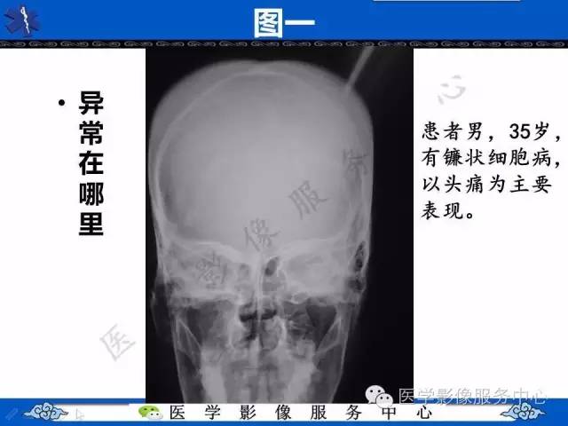 【影像征象】竖毛征——重度贫血