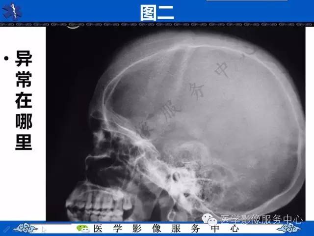 【影像征象】竖毛征——重度贫血