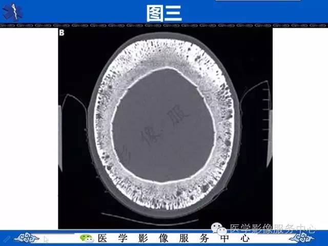 【影像征象】竖毛征——重度贫血