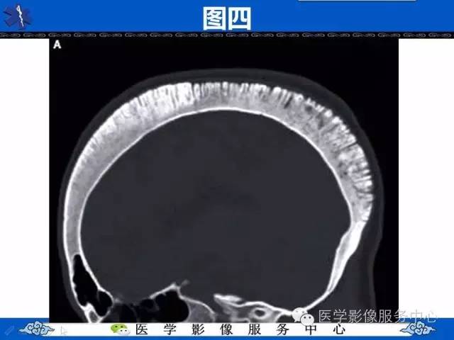 【影像征象】竖毛征——重度贫血