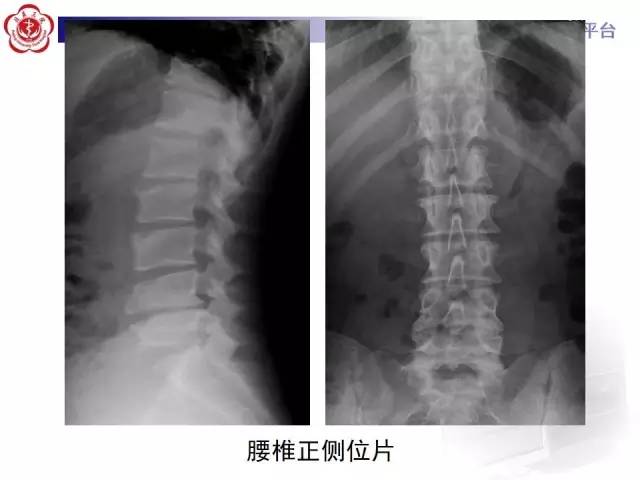 【病例】脊柱休门氏病1例X线及MR影像表现