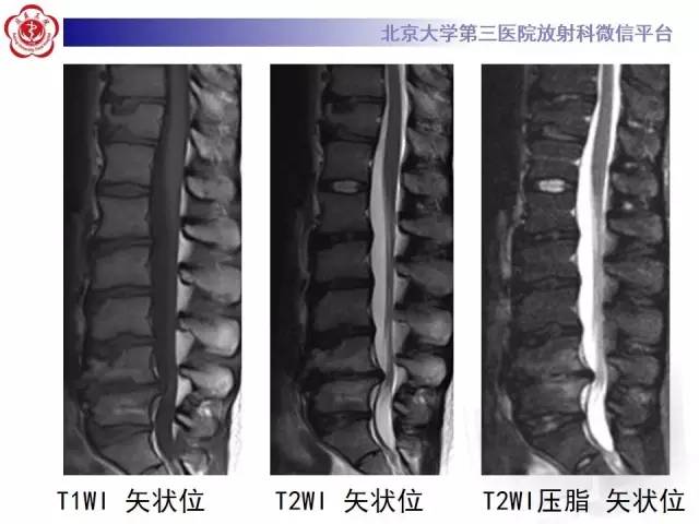 【病例】脊柱休门氏病1例X线及MR影像表现