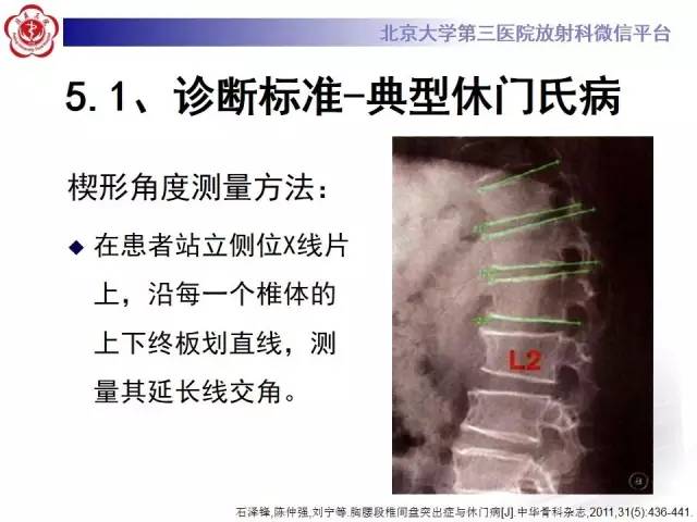 【病例】脊柱休门氏病1例X线及MR影像表现
