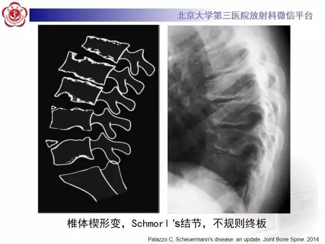 【病例】脊柱休门氏病1例X线及MR影像表现