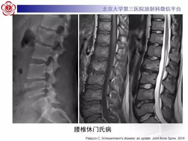 【病例】脊柱休门氏病1例X线及MR影像表现