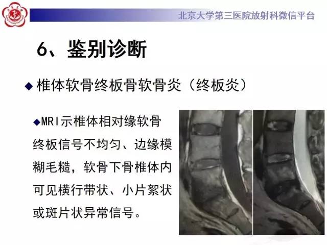 【病例】脊柱休门氏病1例X线及MR影像表现