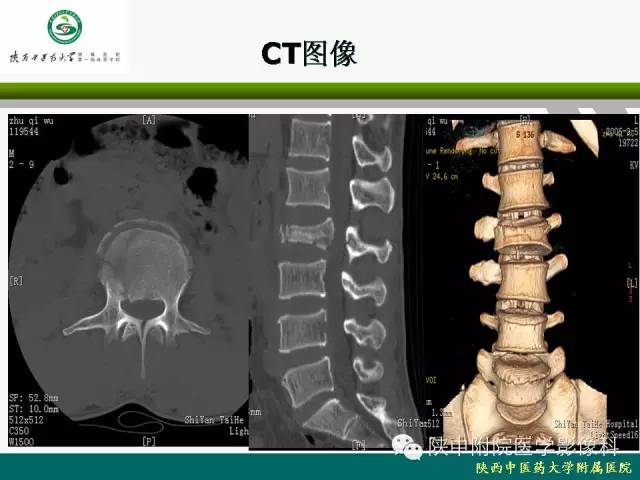 【PPT】脊柱肿瘤的影像学诊断