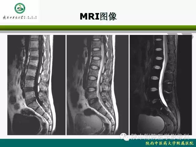 【PPT】脊柱肿瘤的影像学诊断