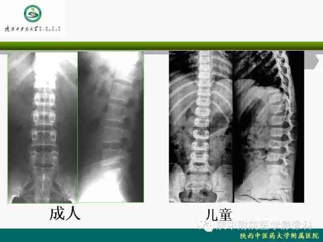 【PPT】脊柱肿瘤的影像学诊断
